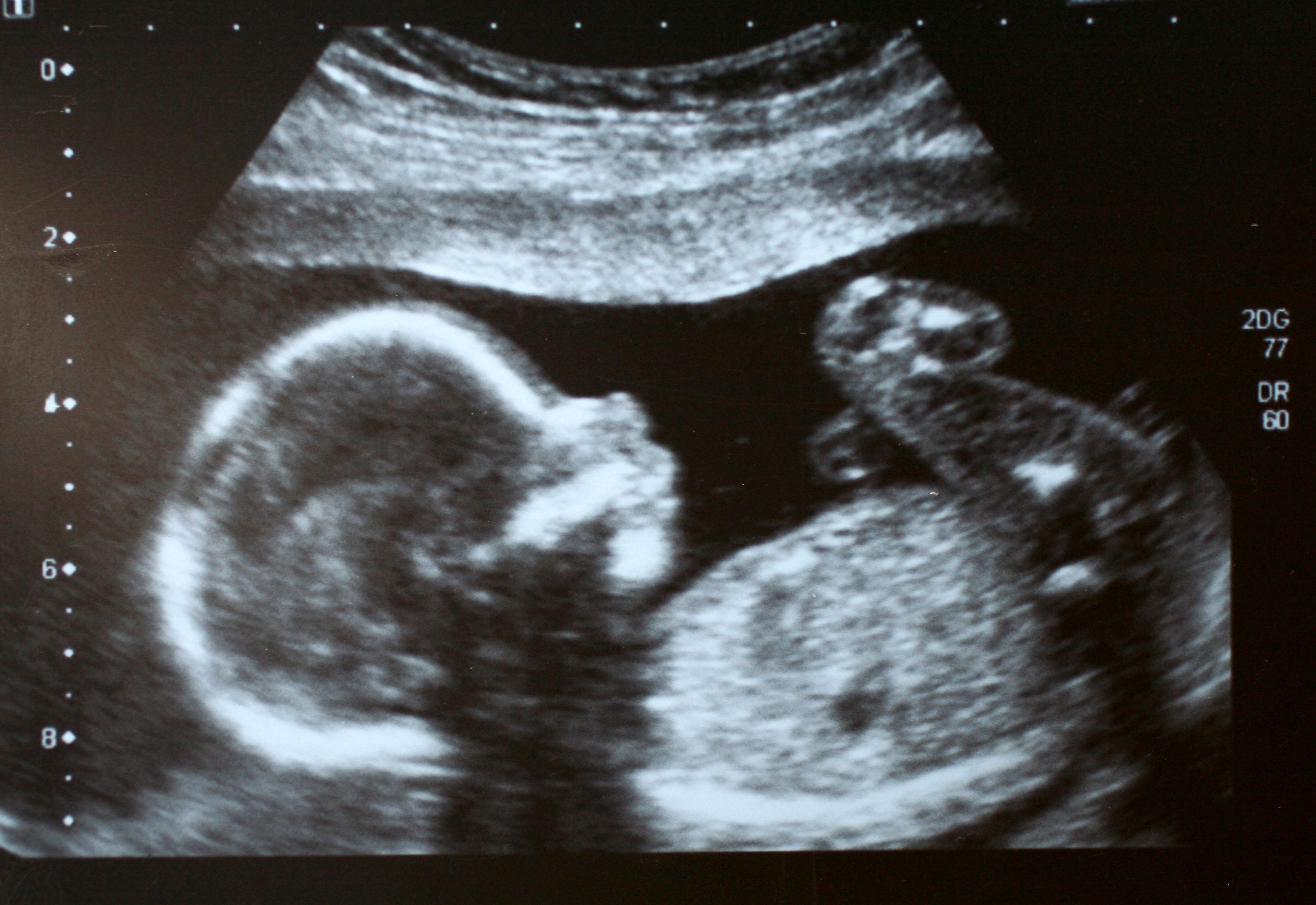 Узи на 39 неделе. УЗИ ребенка на 22 неделе беременности. 20 Недель беременности фото плода на УЗИ. Снимок УЗИ беременности 20 недель. УЗИ плода на 22 неделе беременности.