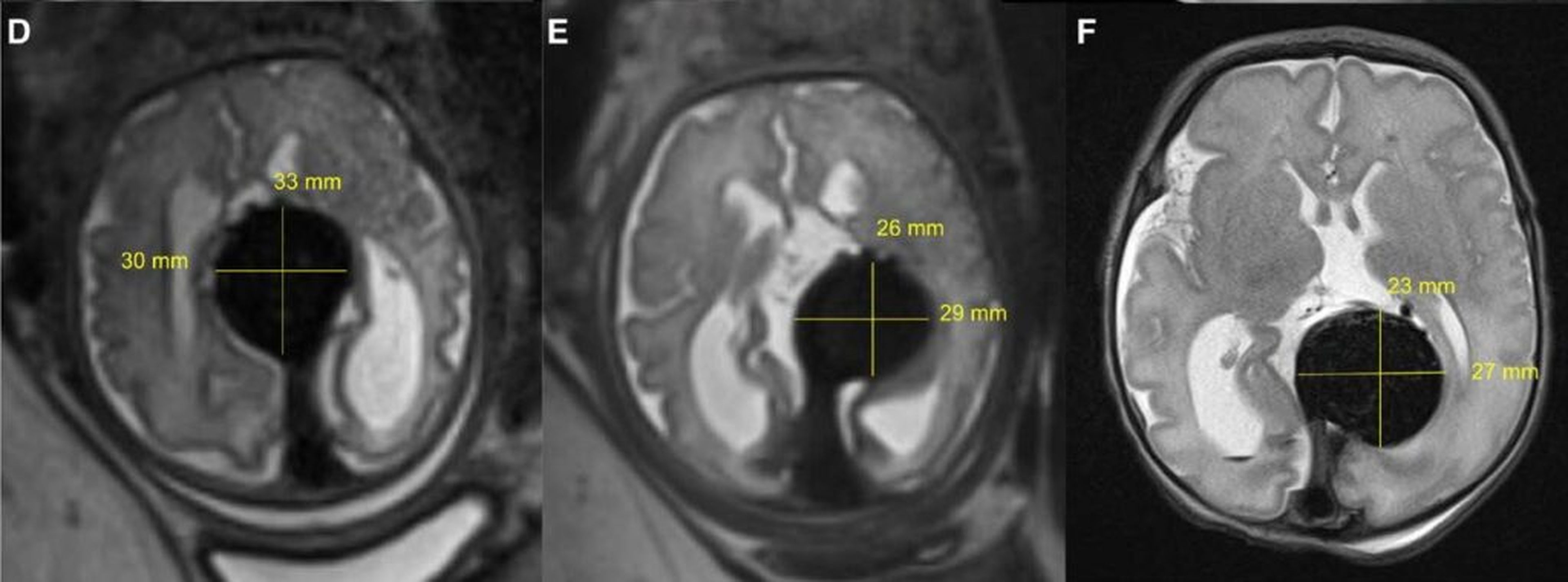 Escáneres del cerebro del bebé que muestran el tamaño de la anomalía a medida que se reduce, desde la izquierda: antes de la embolización, justo después y justo después de nacer el bebé.