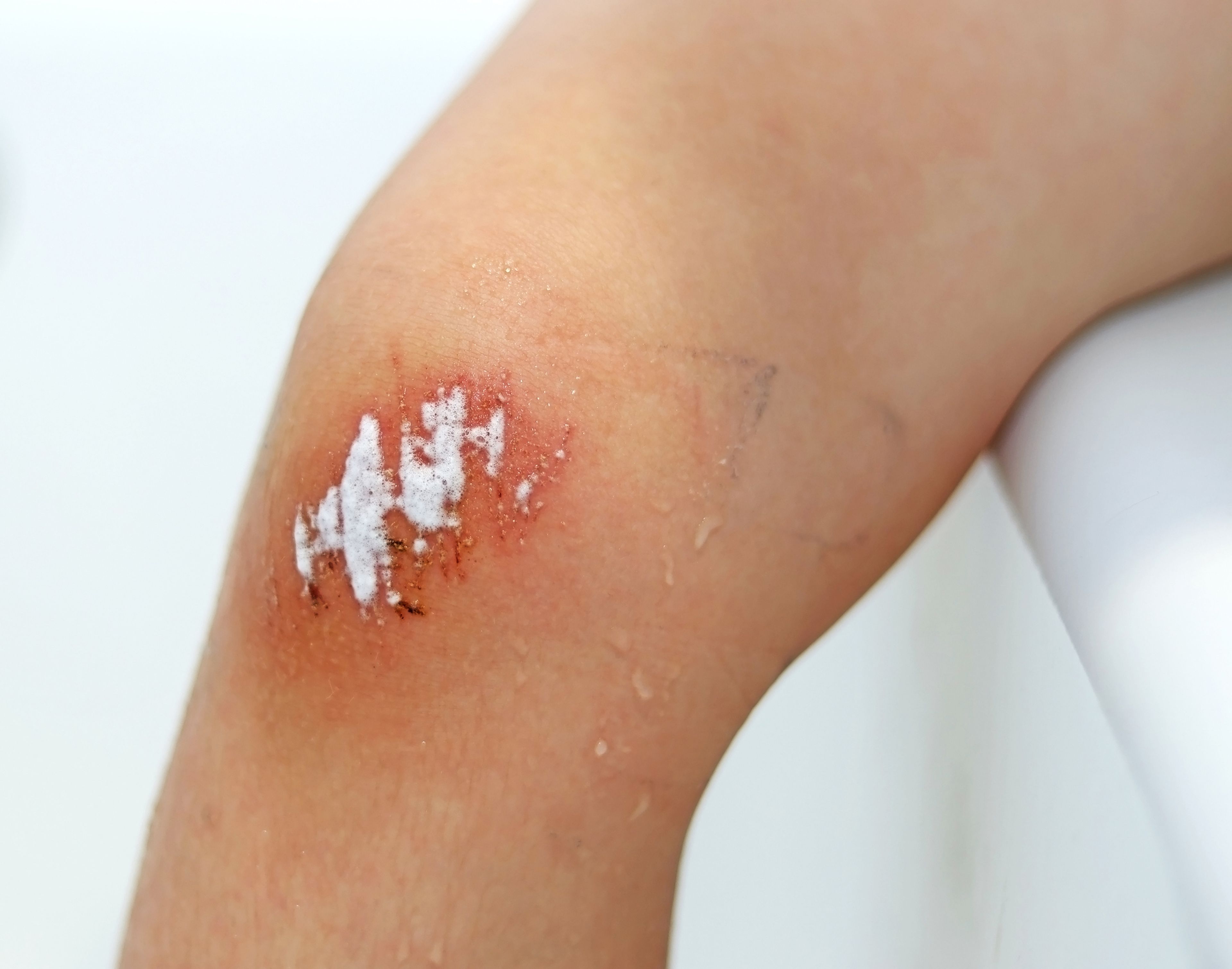La rodilla de una persona con una herida en la que se ha echado agua oxigenada.