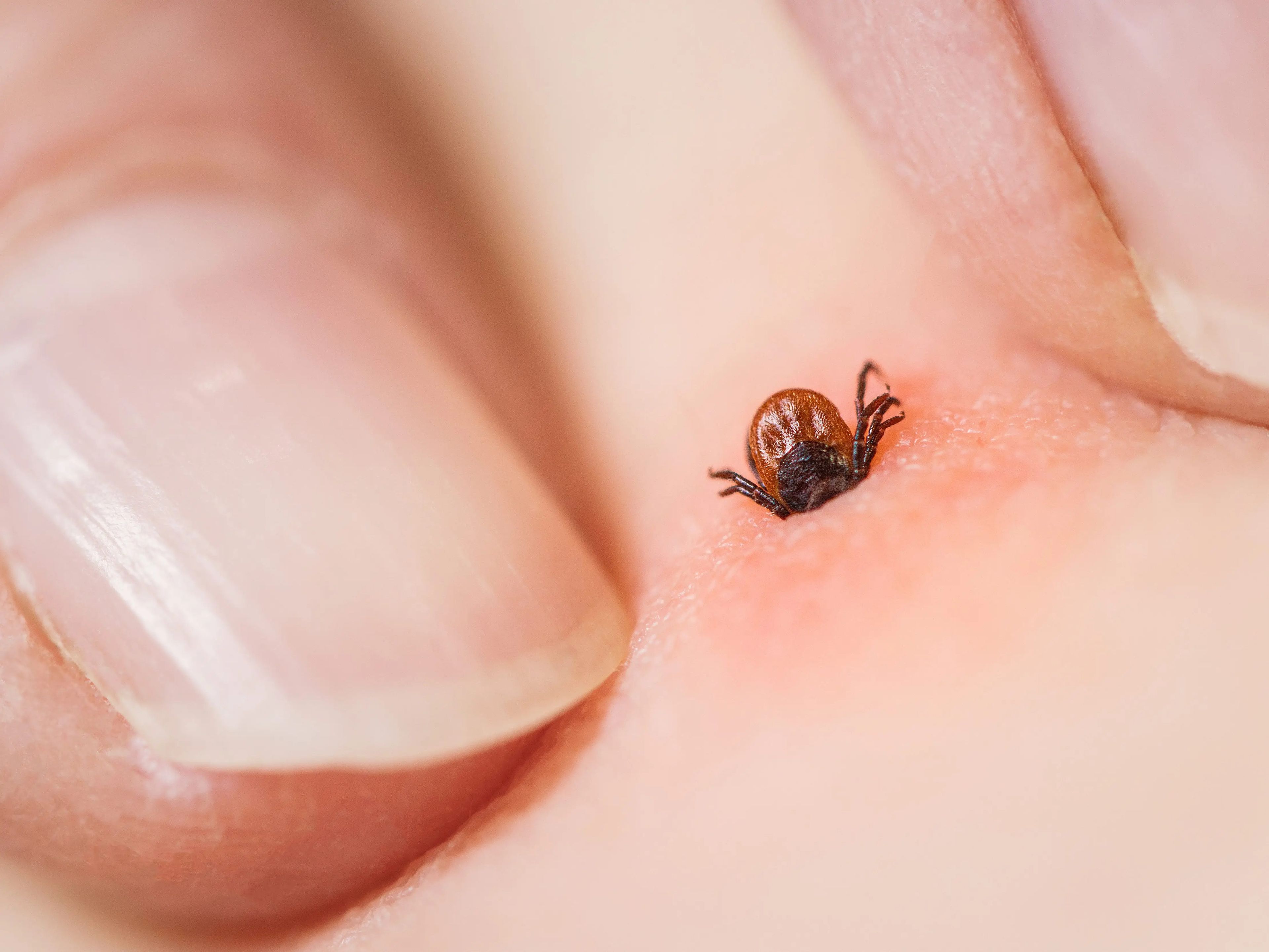 Close-up of a tick attached to a person.touching the skin on either side of the tick with your fingers