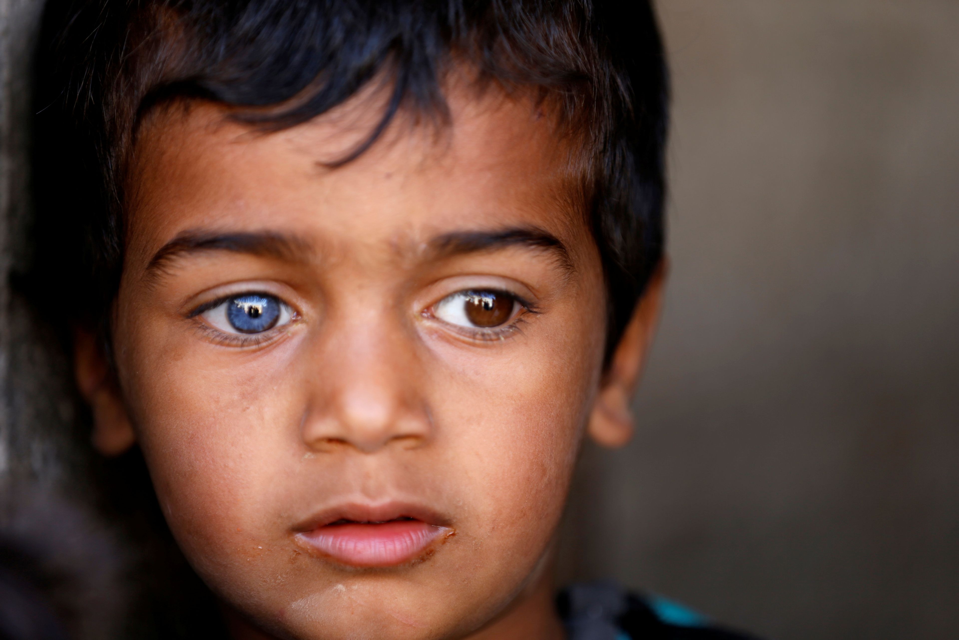 Un niño con un ojo de cada color en Yemen.