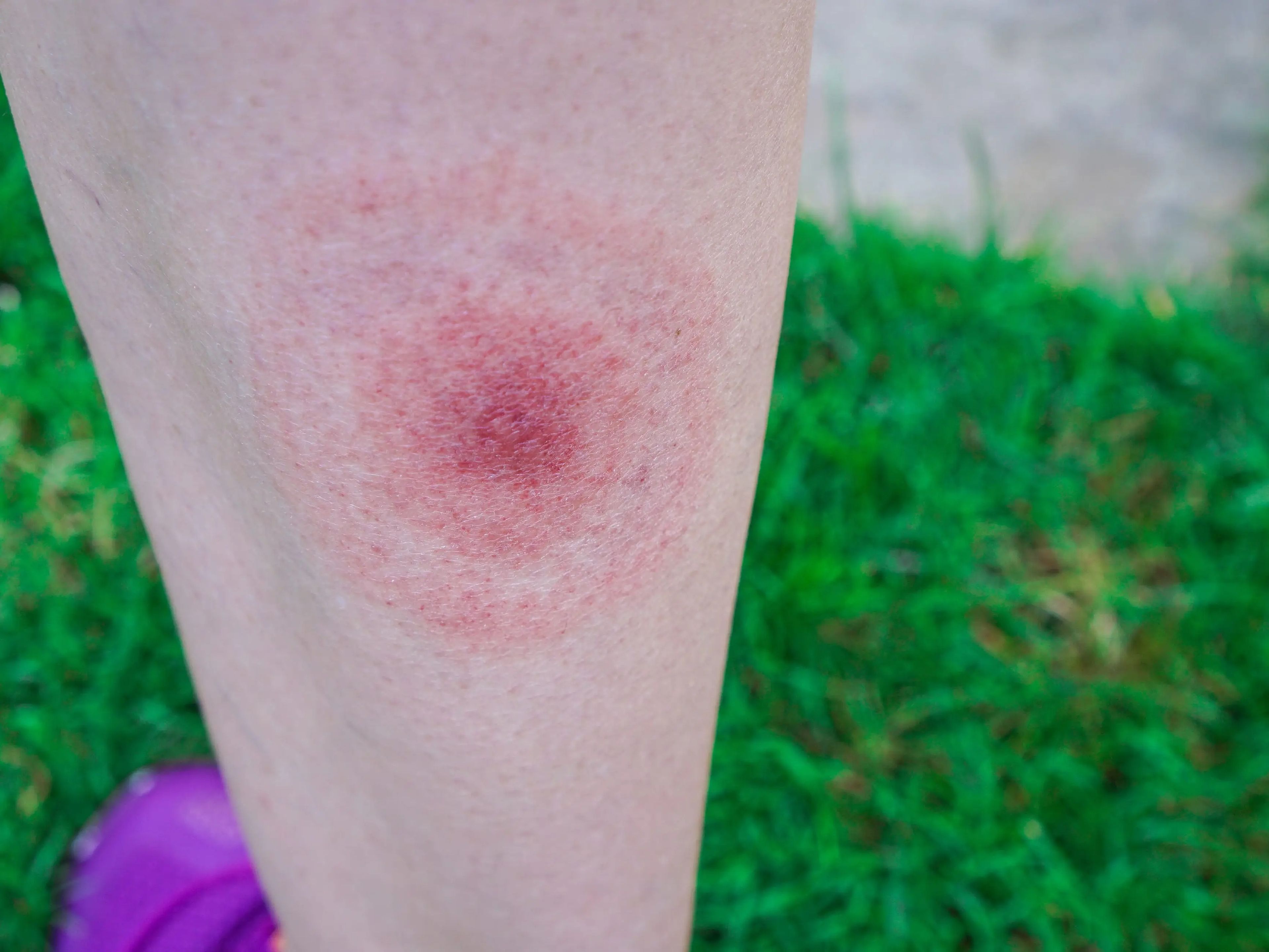 A common bull's-eye rash on the legs of people with Lyme disease.