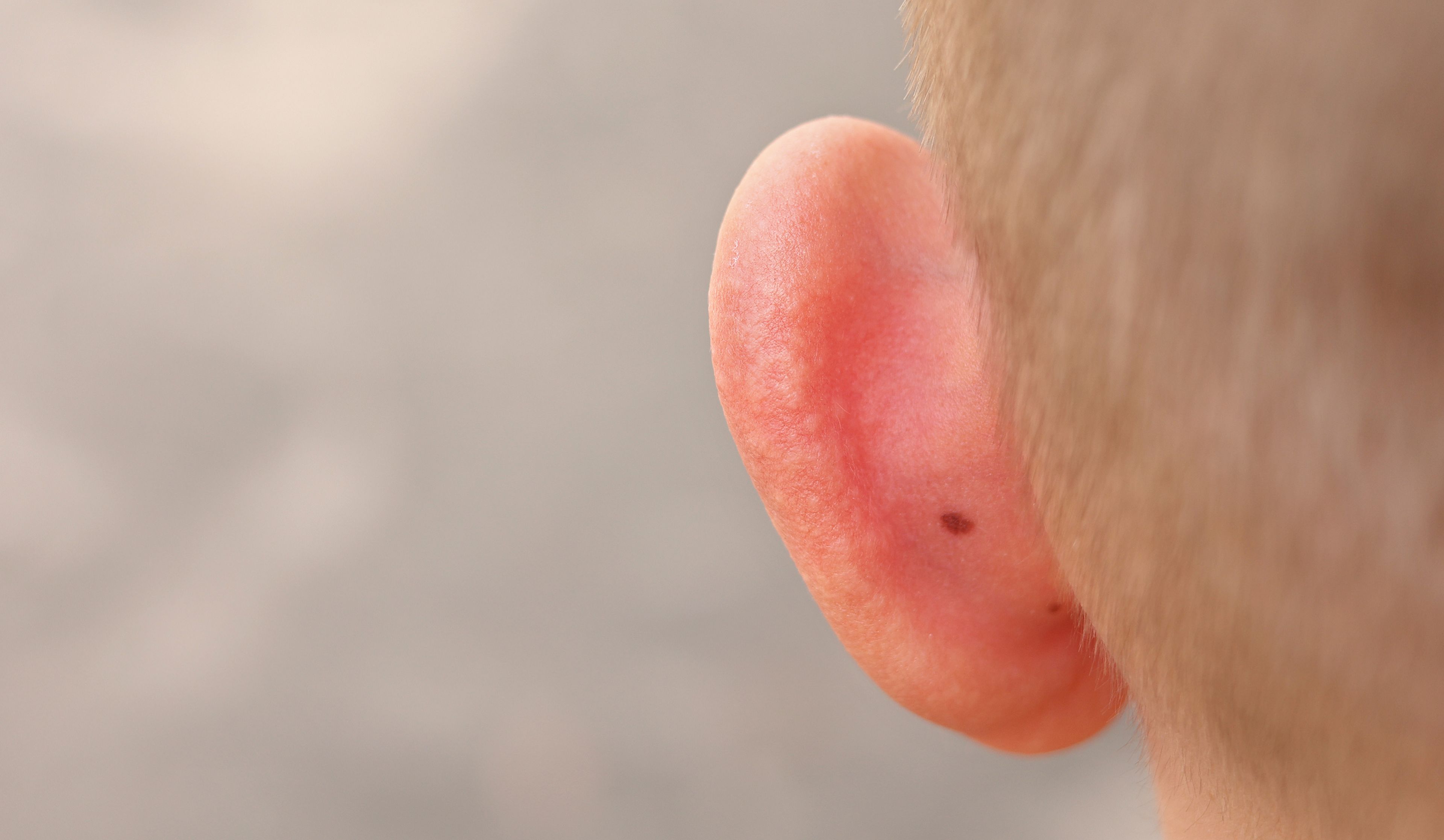 Un bebé con la parte detrás de la oreja enrojecida.