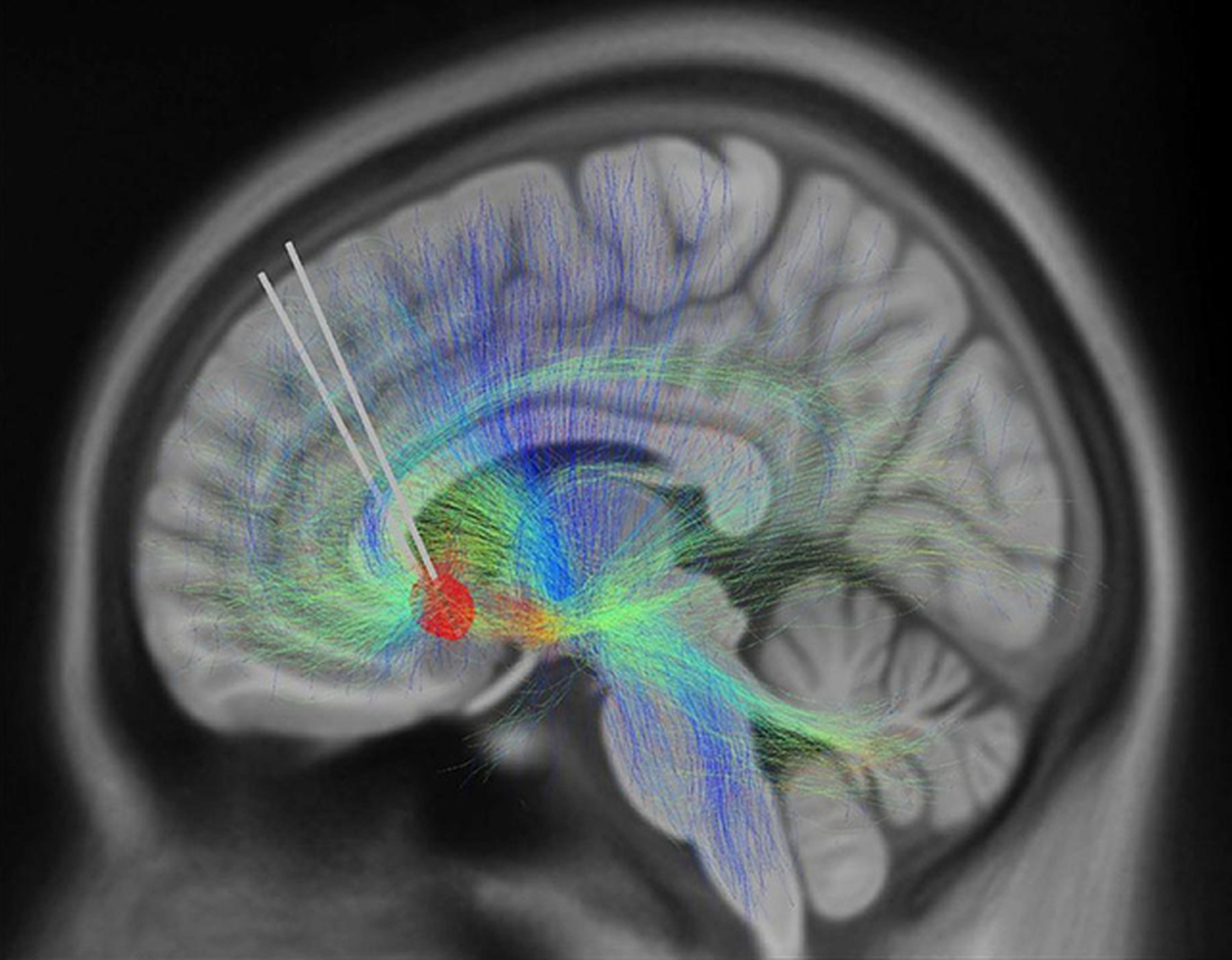 Los escáneres cerebrales detectaron un biomarcador para la recuperación de la depresión.