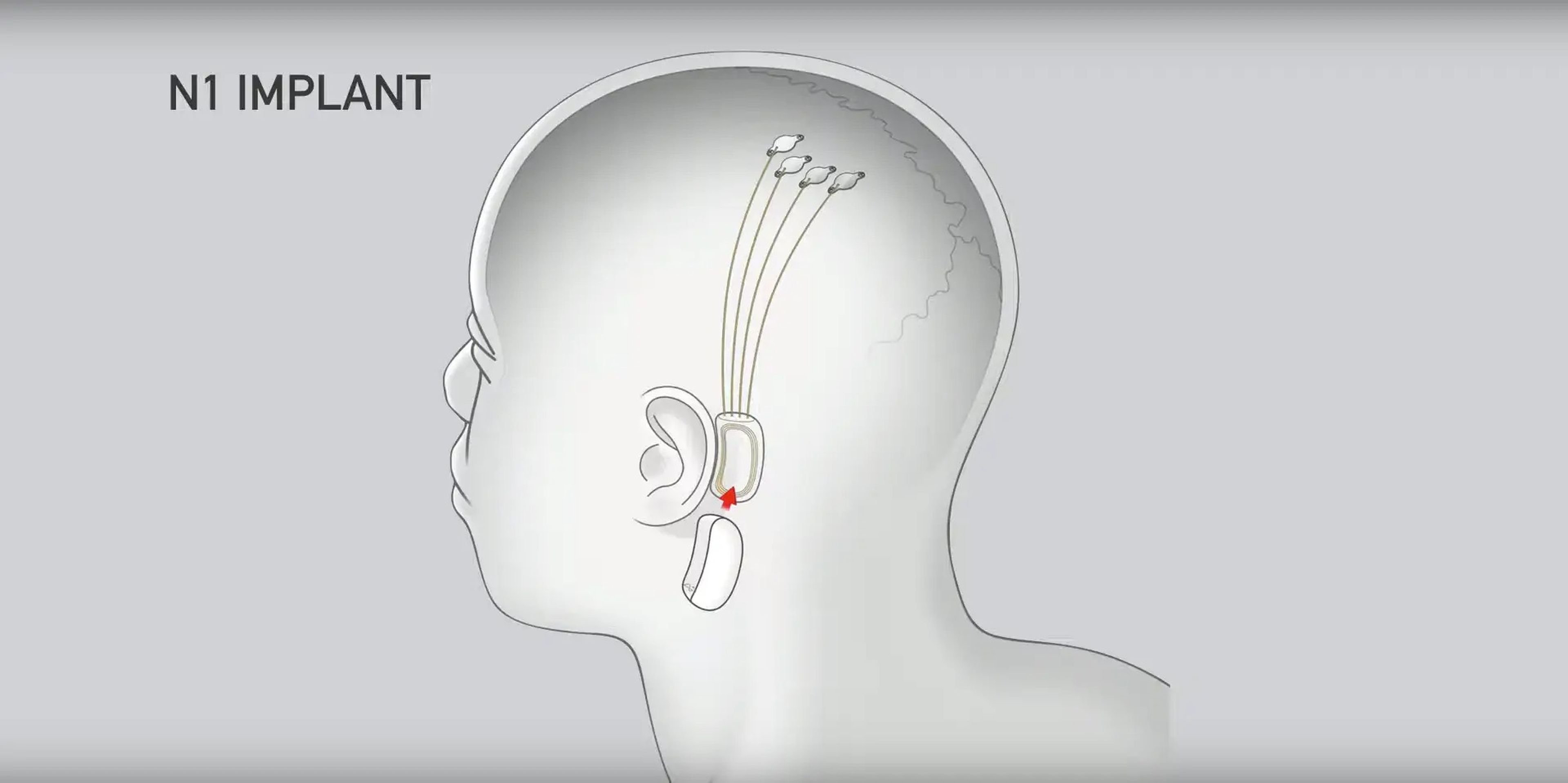 El chip Neuralink se coloca detrás de la oreja.
