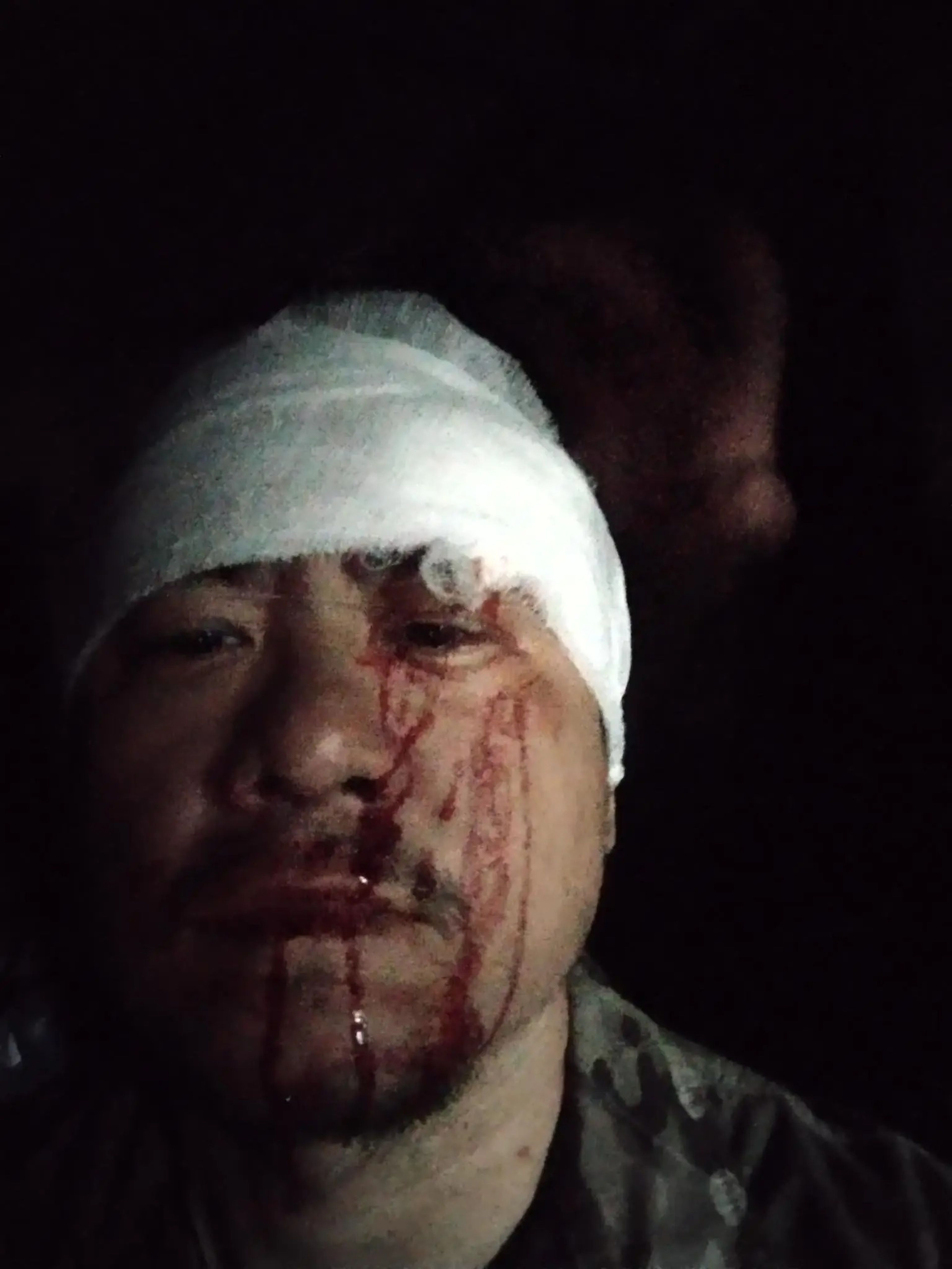 Jackie tras recibir un impacto de metralla en la cara en Bajmut. 