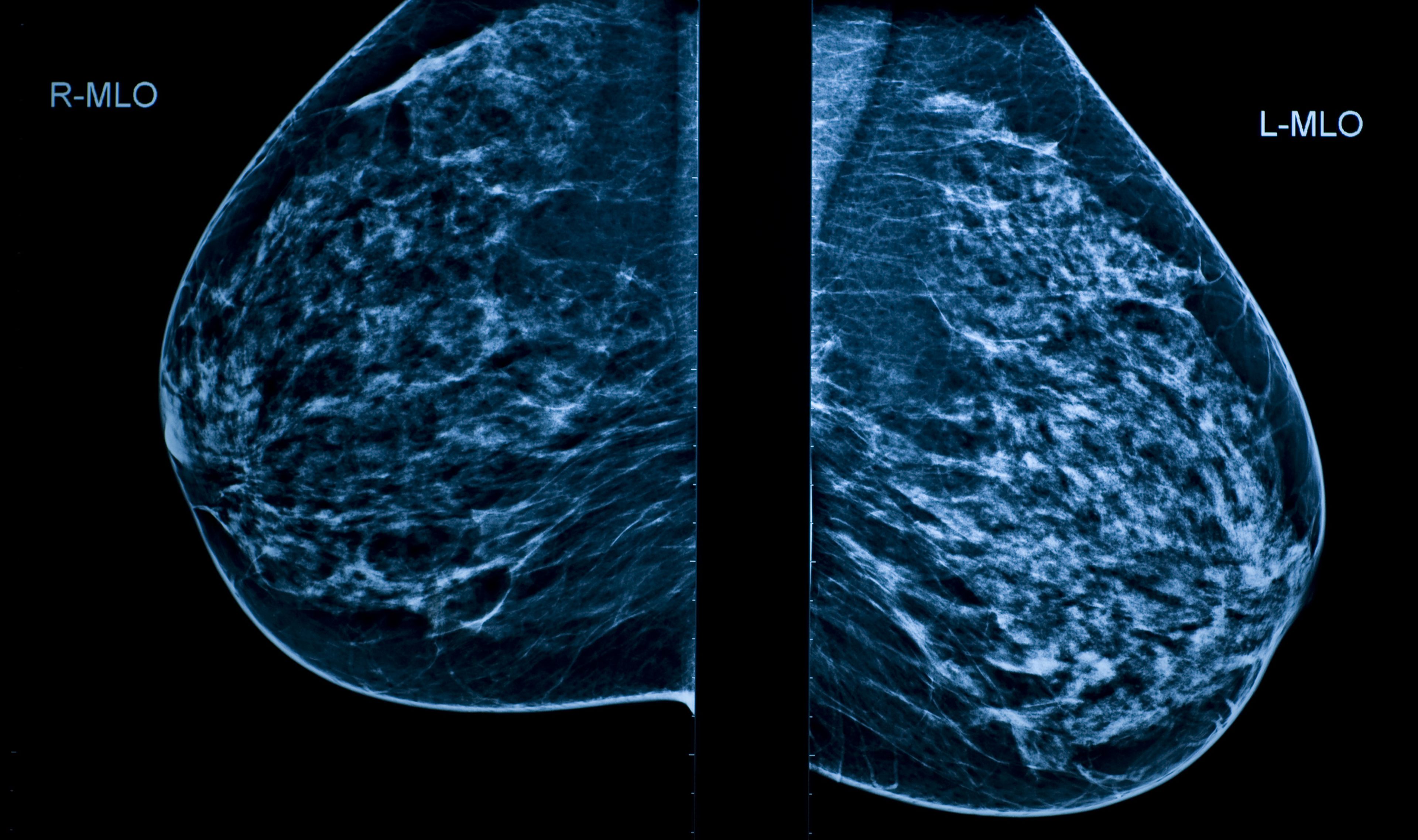 En las mamogramas, el tejido mamario denso se ve blanco. Los tumores también aparecen en blanco, por lo que pueden pasar desapercibidos en mamas muy densas.