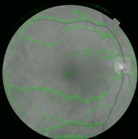 A partir de imágenes como ésta, los investigadores pudieron identificar exactamente a qué área estaba prestando atención el sistema de inteligencia artificial al evaluar el riesgo.