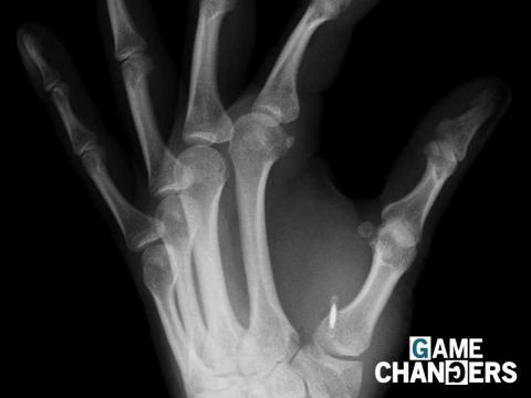 Una radiografía de una mano con un microchip implantado.