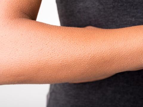 Arrector pili are muscle fibers that produce goose bumps when they contract. Our ancestors, who had a lot more body hair, used these fibers to their advantage, but we don't have a use for them anymore.