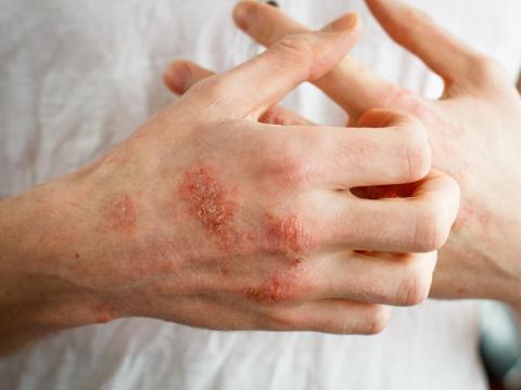 High blood sugar can mess with your blood flow, which can slow healing.