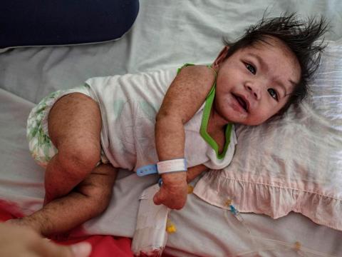 A Filipino child with the measles at a government-run hospital on May 4, 2019 in Manila, Philippines. The Department of Health in the Philippines declared an outbreak of measles early this year, with a total of 31,056 measles cases from January to April