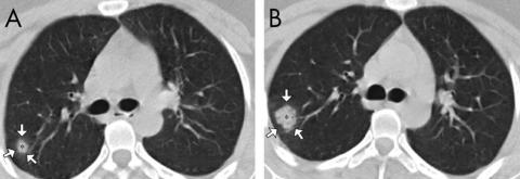 Scans from a 27-year-old woman who worked in Wuhan showed a "ground-glass halo" — white patches that surround a small nodule.