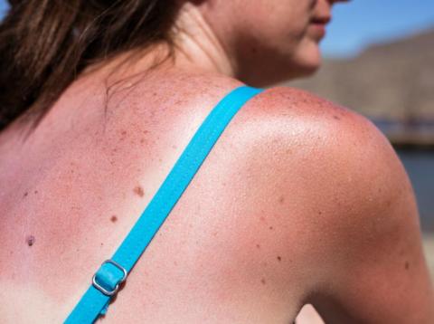 Sun poisoning, a severe sunburn, is no joke. Sun poisoning, a severe sunburn, is no joke.