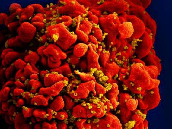 Scientists say a man with HIV is the first to reach long-term remission without a bone marrow transplant, but their peers are skeptical